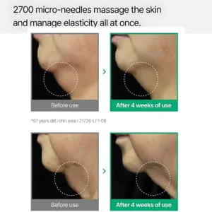 how micro needles manage elasticity of skin
