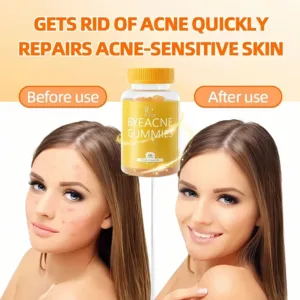Get rid of acne quickly repairs acne sensitivity skin